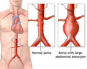 Aneurysmal Disease