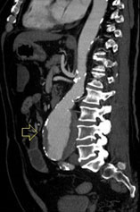 Aneurysmal Disease