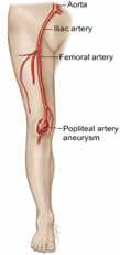 Aneurysmal Disease