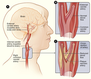 Carotid Disease