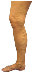 Varcoise Veins