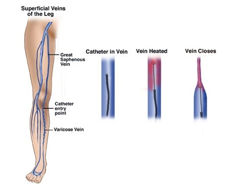Superficial Veins of the Leg